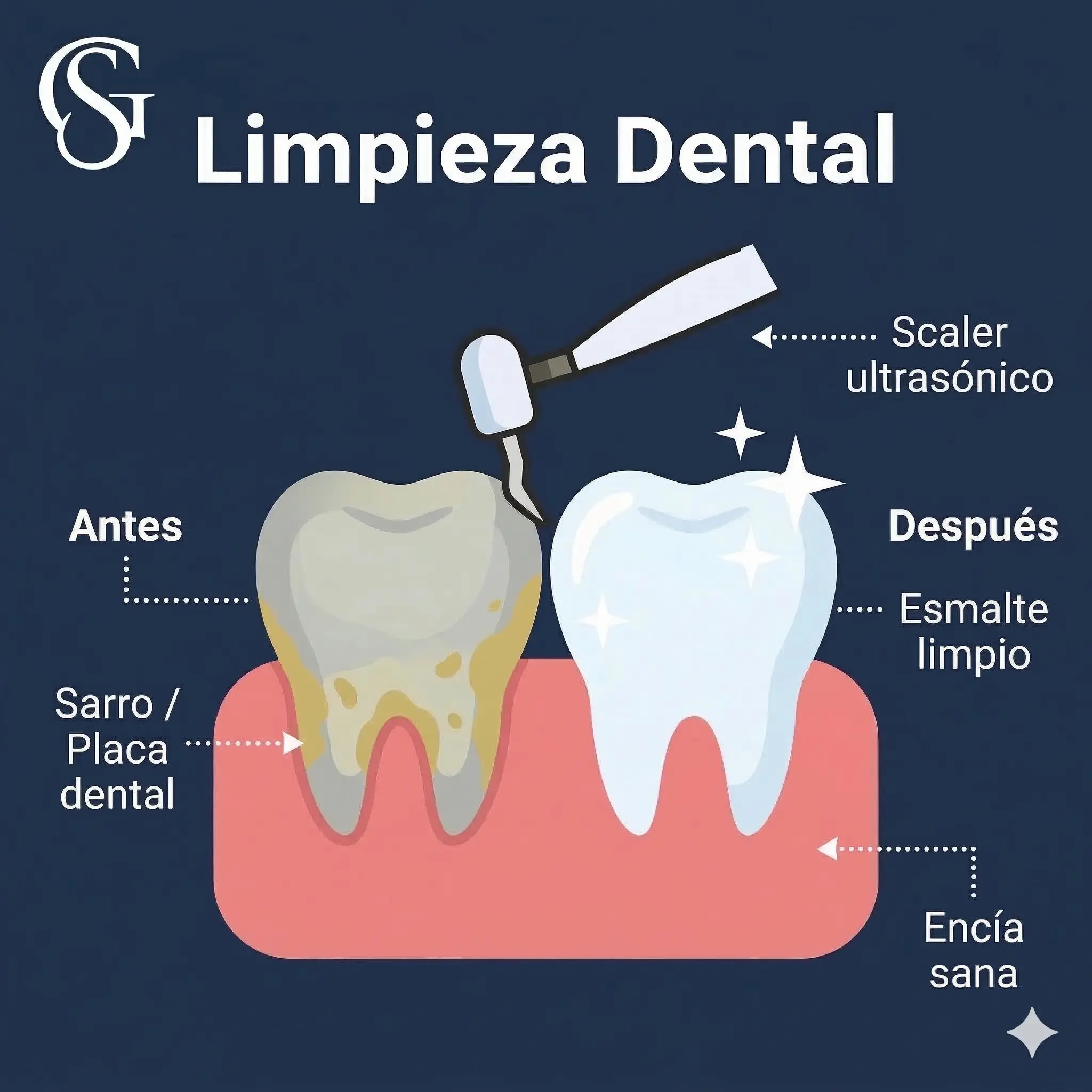 Limpieza Dental